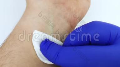 一位身穿蓝色医用手套的医生用医用酒精将棉絮裹住，并擦拭他将血液用于分析的地方